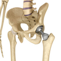 Philadelphia hip replacement lawyers represent those harmed by defective medical devices.
