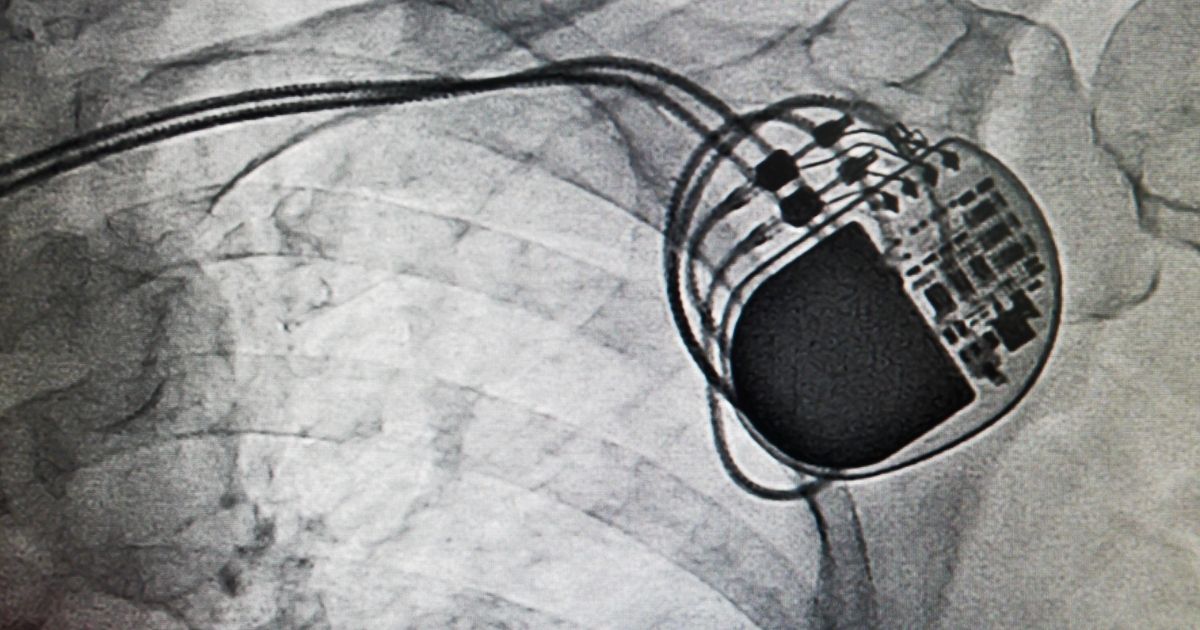 Philadelphia Defective Medical Device Lawyers at Brookman, Rosenberg, Brown & Sandler Seek Justice for Those Harmed by Faulty Ventricular Assist Devices.